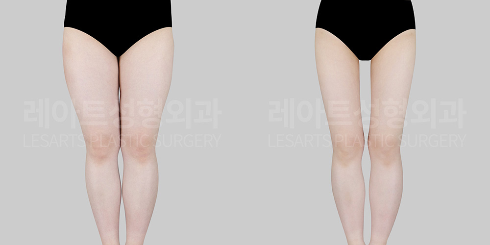 thigh liposuction before and after-lesarts plastic surgery