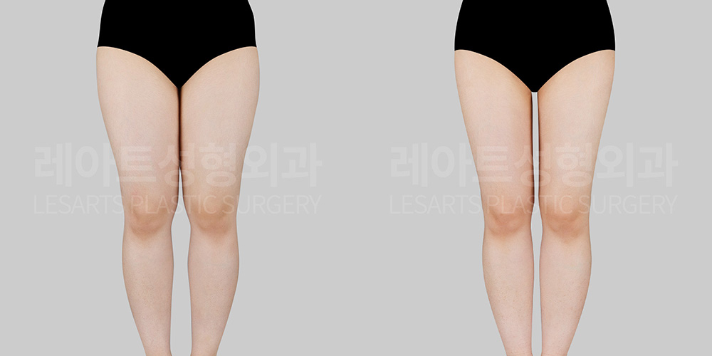 lesarts thigh liposuction before after