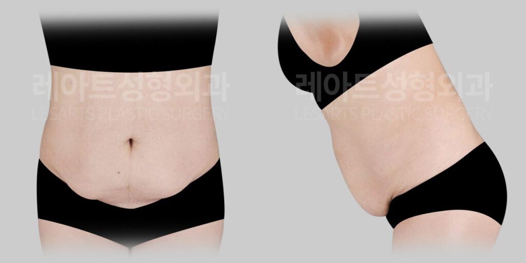 tummy-tuck-02-01-260721