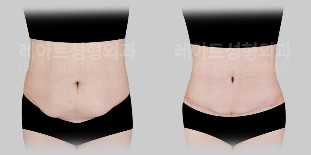 Tummy tuck in Gangnam: causes and treatment of lower abdominal sagging after childbirth