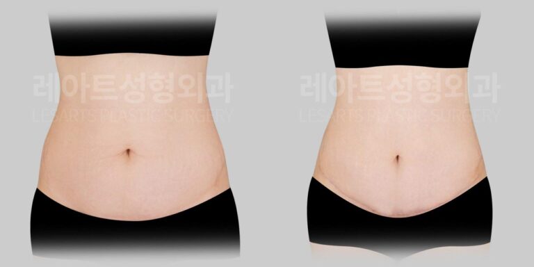 tummy tuck before and after - lesarts plastic surgery
