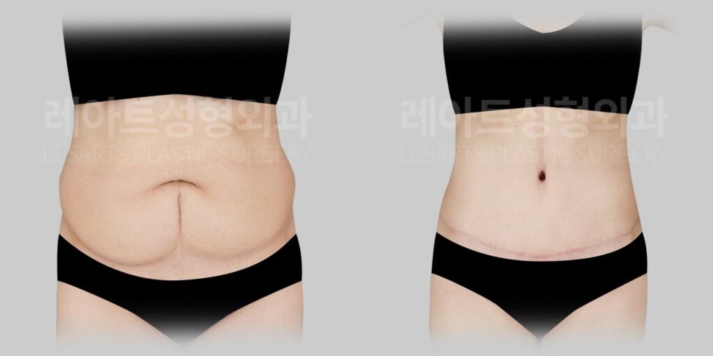 Tummy tuck in Seoul for a woman in her 60s: C-section scar and lower abdominal sagging at 3.5 months
