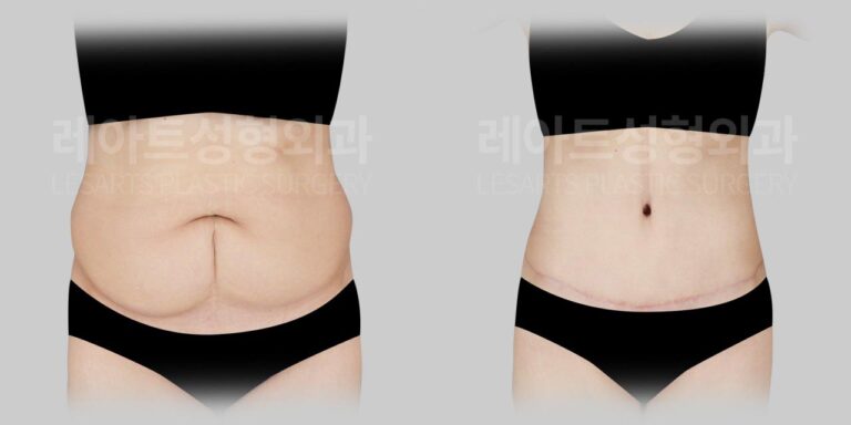 tummy tuck before and after - lesarts plastic surgery