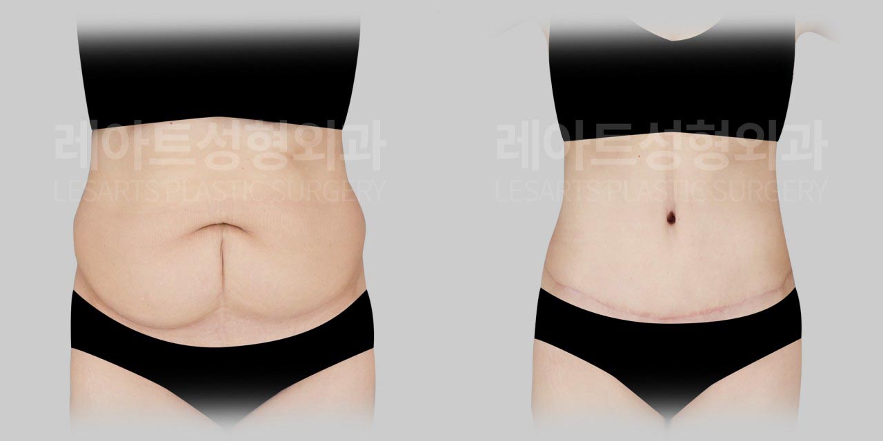 tummy tuck before and after - lesarts plastic surgery