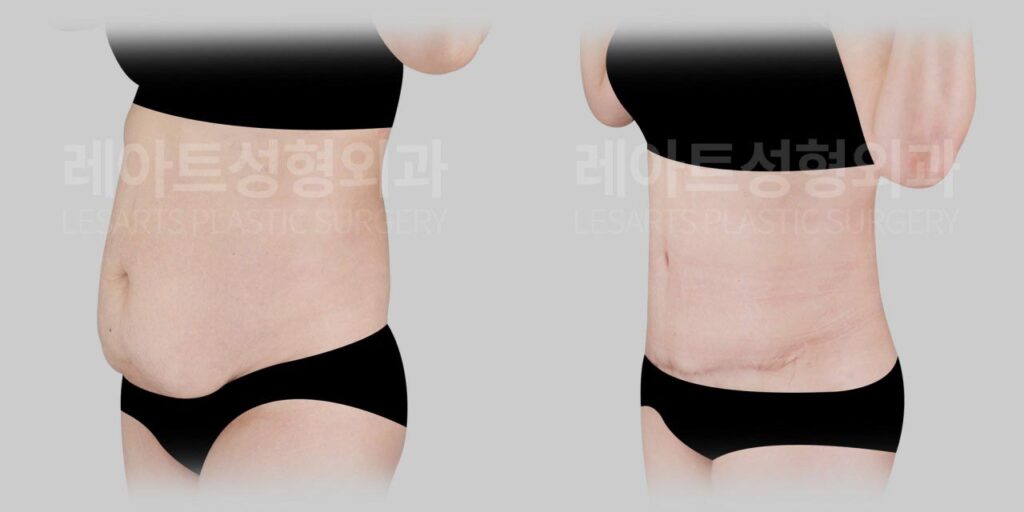 tummy-tuck-02-04-260721
