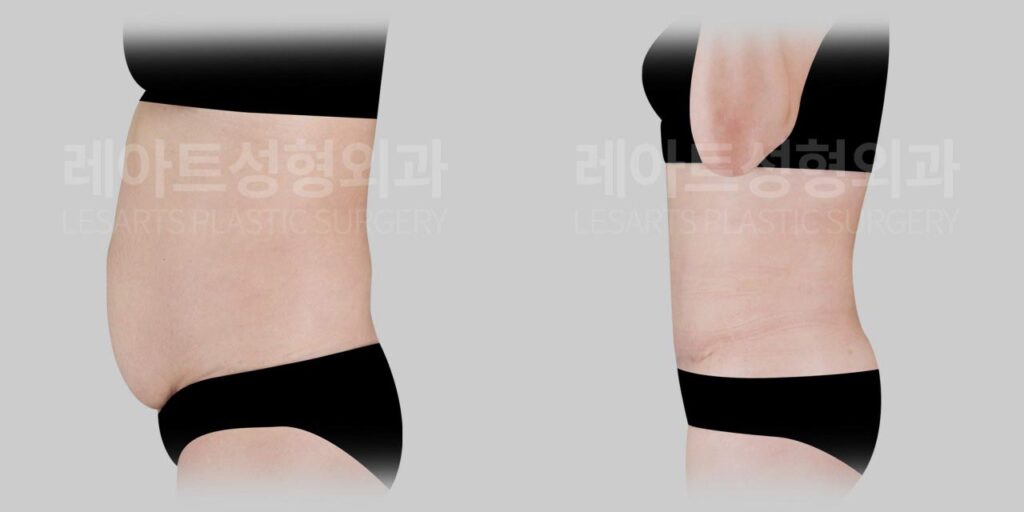 tummy-tuck-02-05-260721