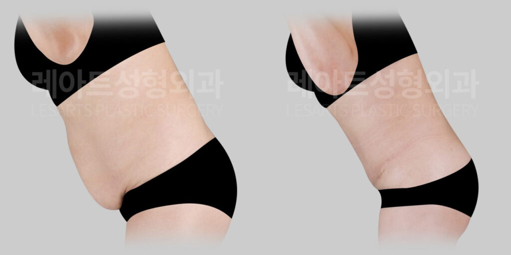 tummy-tuck-02-06-260721