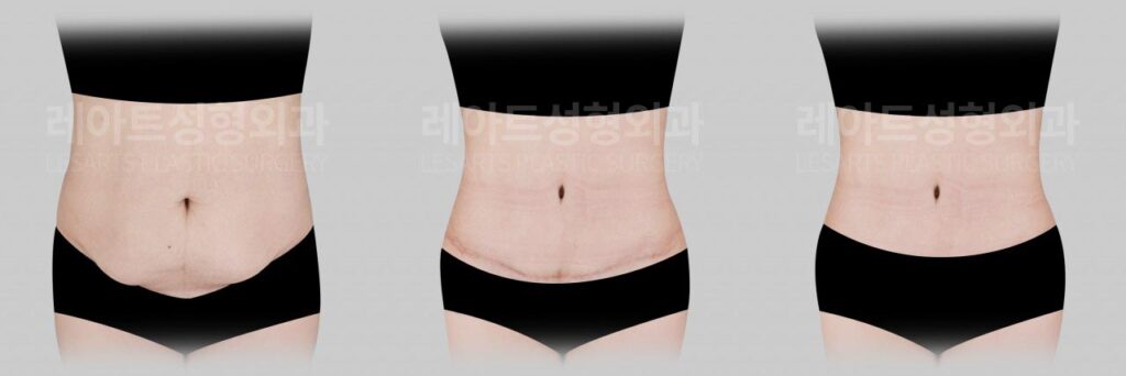 tummy-tuck-02-07-260721