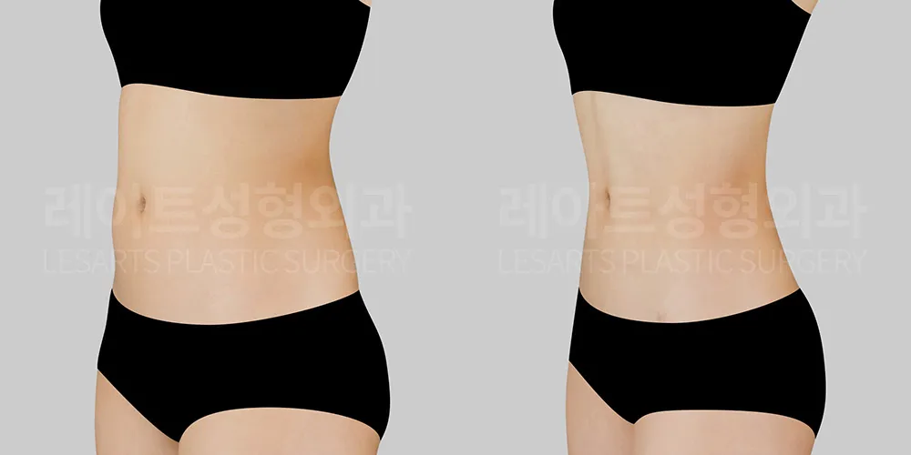 Abdominal Liposuction – Which Areas Should Be Treated for a Flattering Abdomen in Crop Tops and Bikinis?