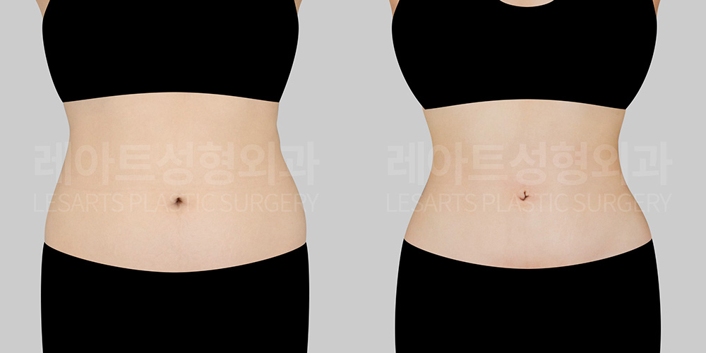 abdominal liposuction before after-lesarts plastic surgery