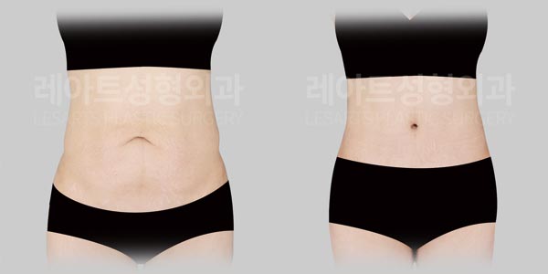 Abdominoplasty in Seoul: why a full abdominoplasty was needed for lower abdominal sagging after childbirth