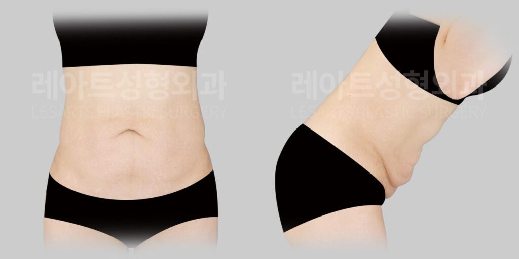 abdominoplasty-02-01-260812