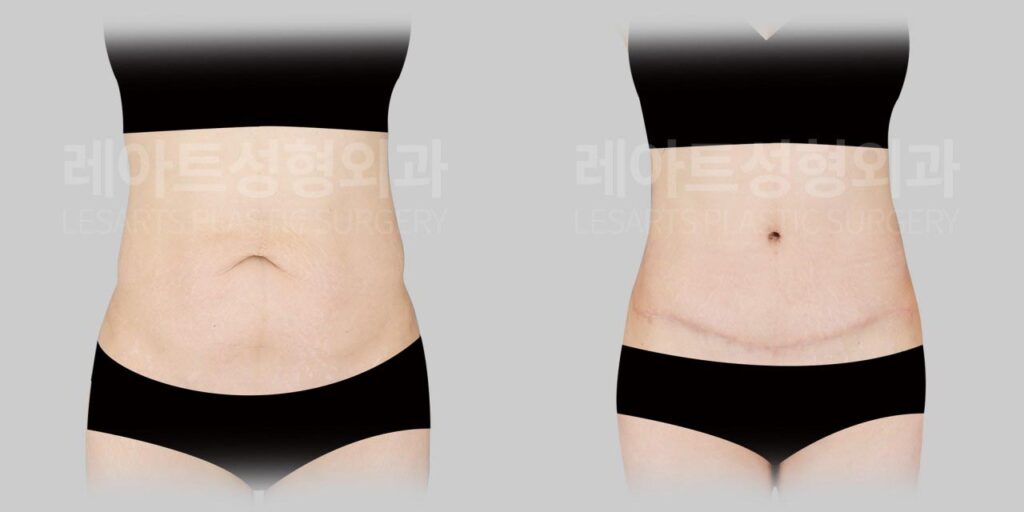 abdominoplasty-02-03-260812