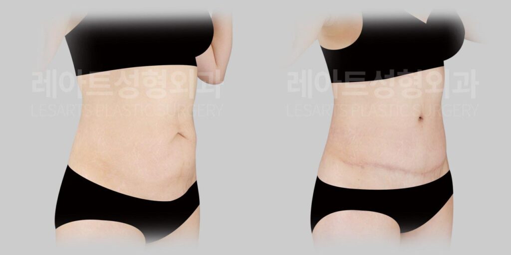 abdominoplasty-02-04-260812