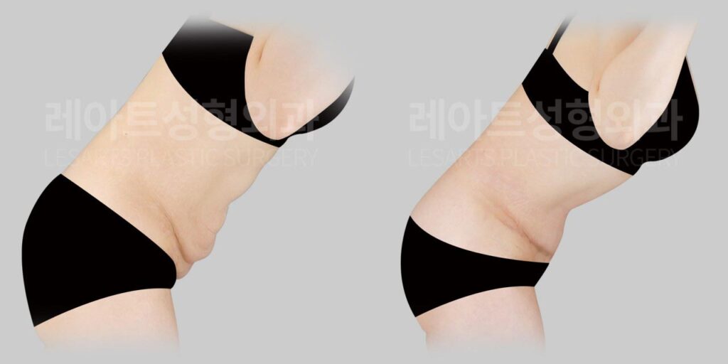 abdominoplasty-02-05-260812