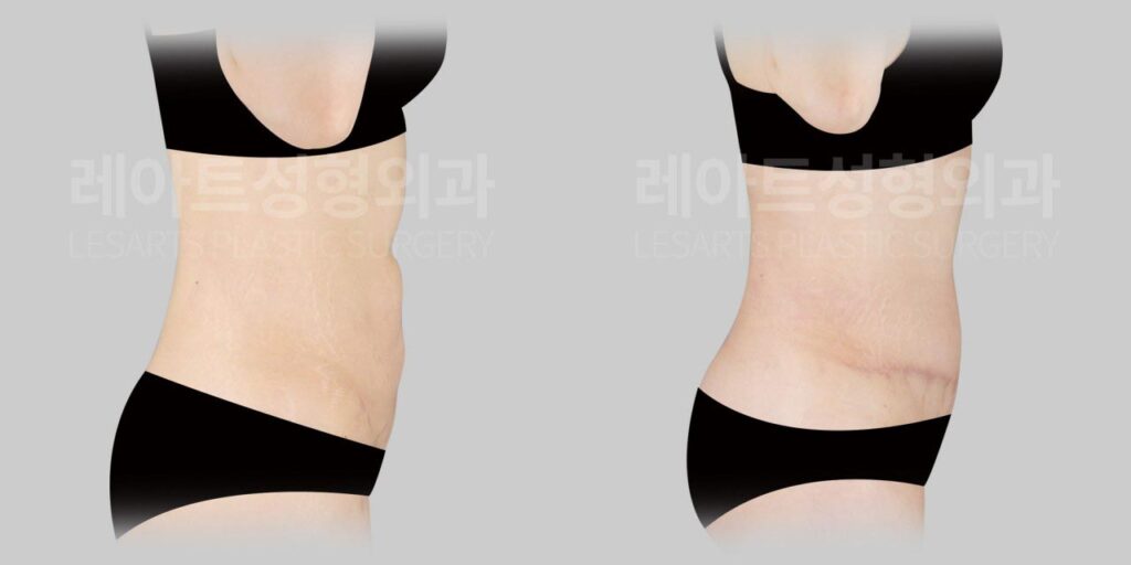 abdominoplasty-02-06-260812