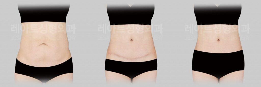 abdominoplasty-02-07-260812