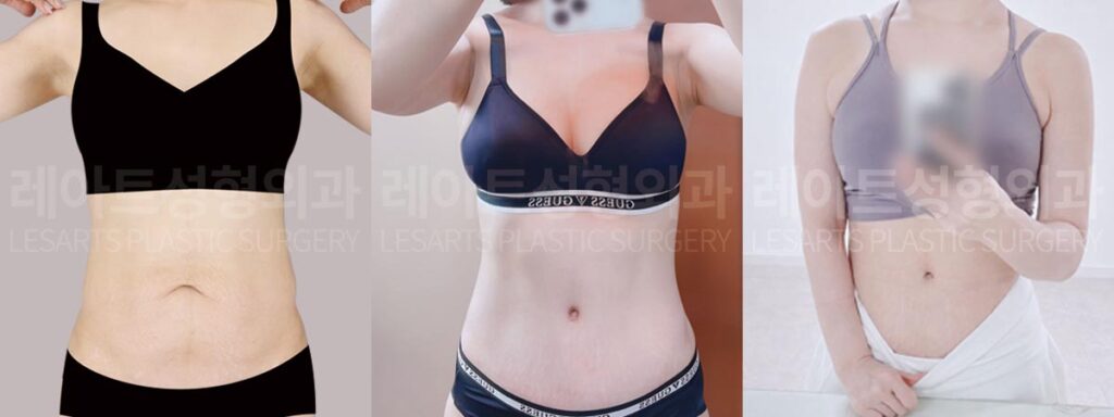 abdominoplasty-02-08-260812