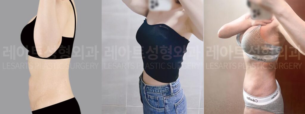 abdominoplasty-02-09-260812