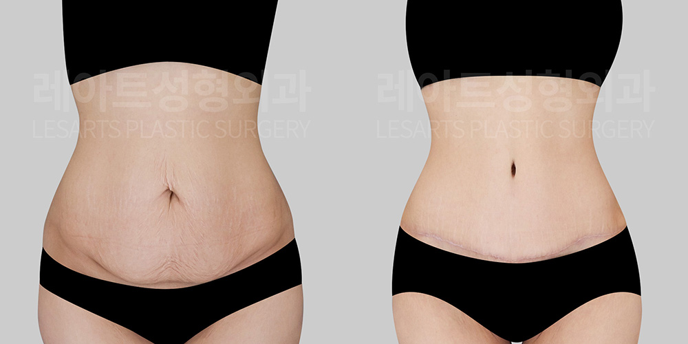 lesarts abdominoplasty before after