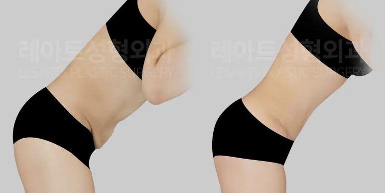 M-Type Full Abdominoplasty – 7-Month Results for Abdominal Skin Laxity and Wrinkles Around the Belly Button