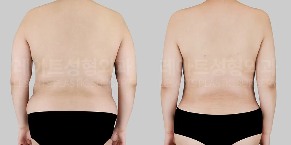 Liposuction for Severe Obesity – Can It Improve Upper-to-Lower Body Proportions?