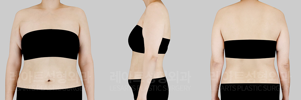 arm-lift-30843-before-01