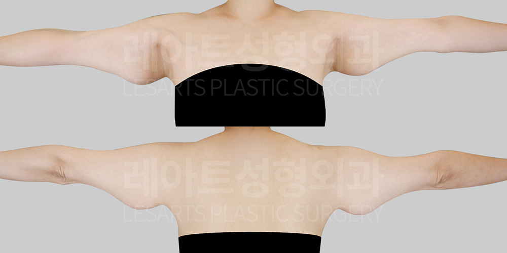 arm-lift-30843-before-02
