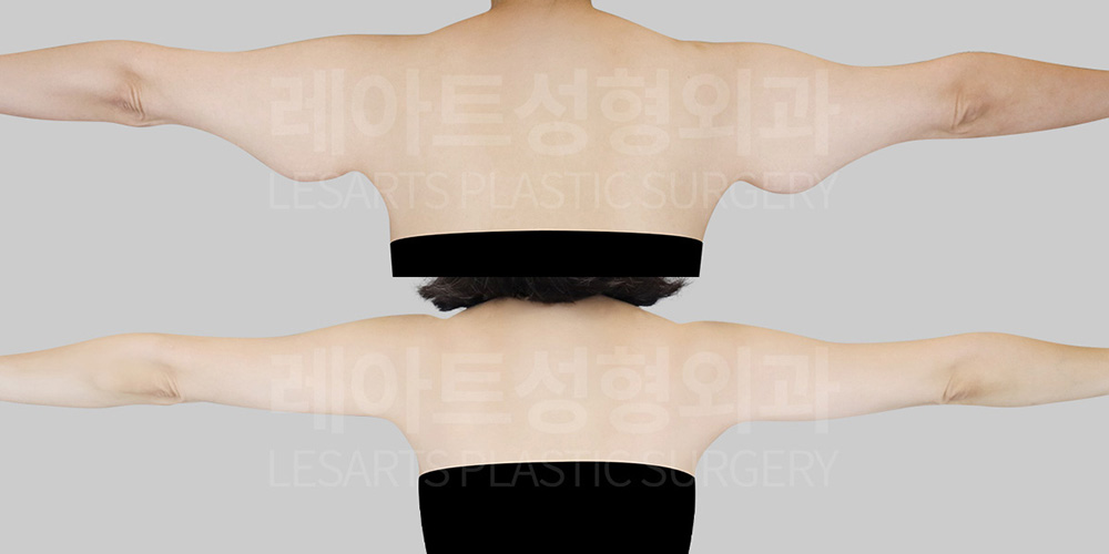 arm-lift-30843-before-after-back-arms-out