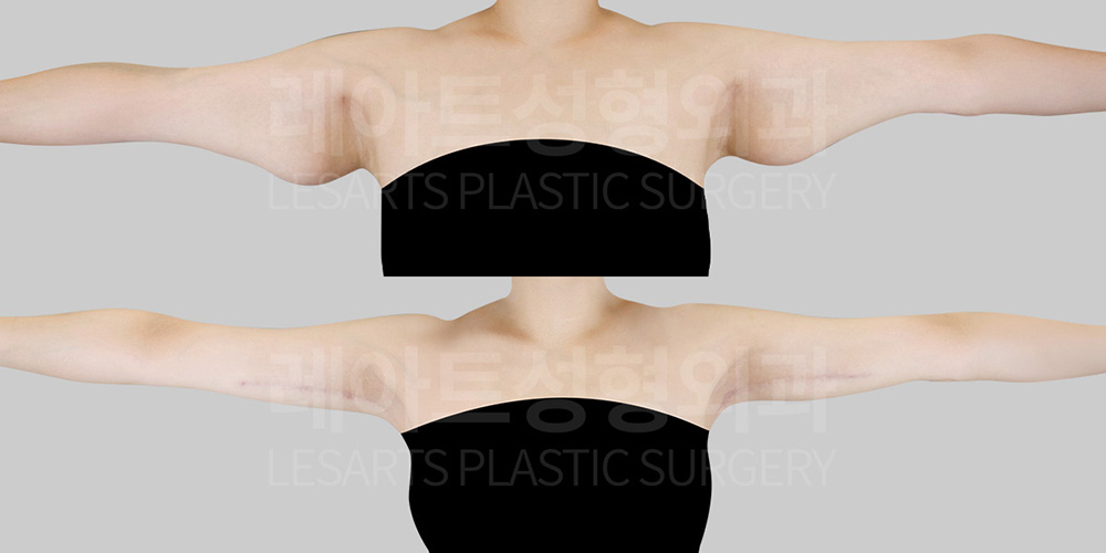 arm-lift-30843-before-after-front-arms-out