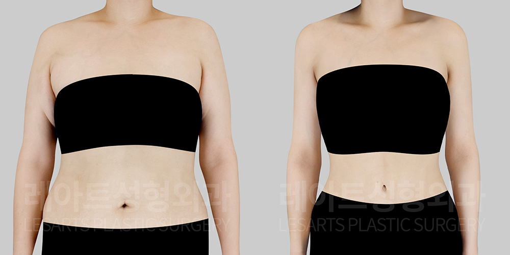 Arm Lift – Sagging Upper Arms After Significant Weight Changes: 7-Month Results After Brachioplasty