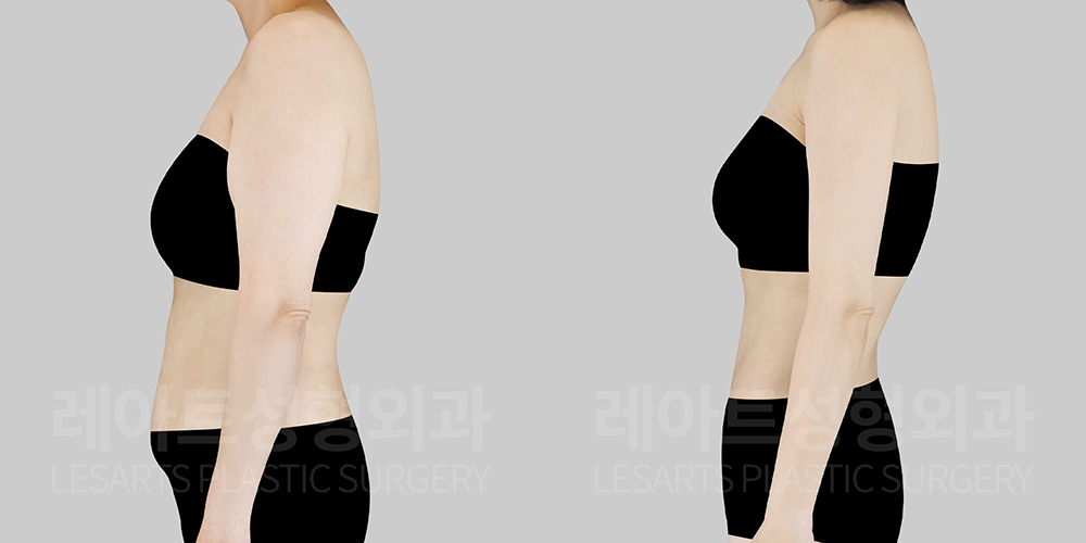 arm-lift-30843-before-after-side