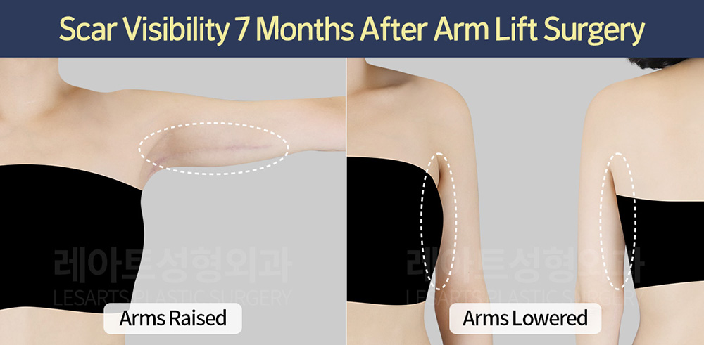 arm-lift-30843-post-surgery-scar-condition