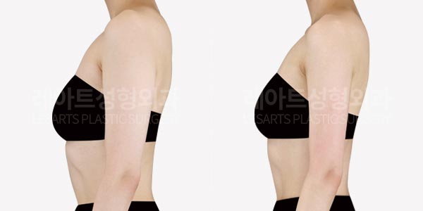 Arm liposuction in Gangnam: can it reduce posterior arm bulges and create a straighter arm line?