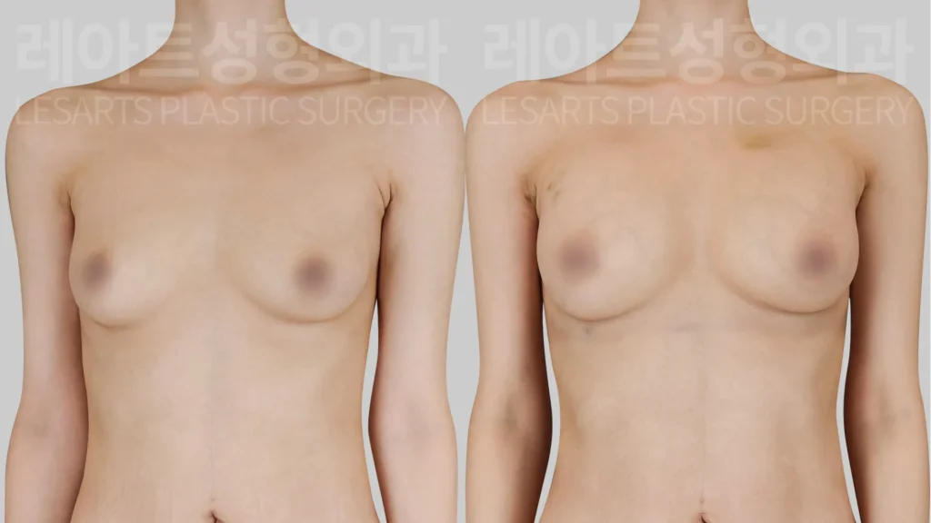 Breast fat transfer in Gangnam: how did a flat upper breast change after 3 months?