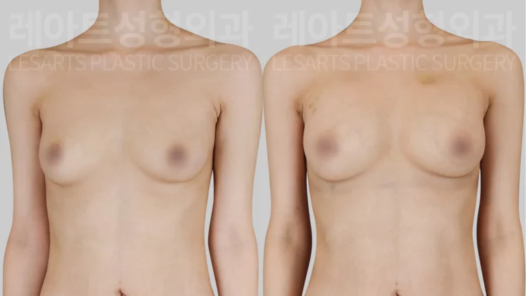 breast-fat-transfer-01-thumbnail-260818