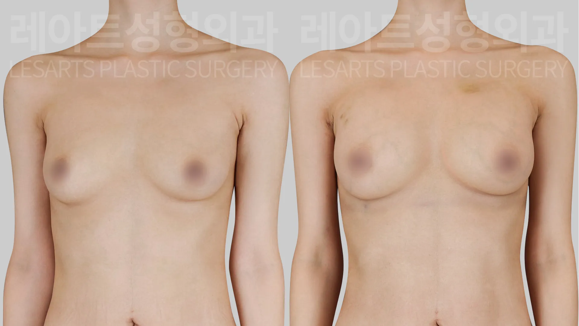 breast-fat-transfer-01-thumbnail-260818