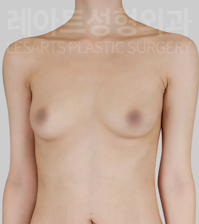 breast-fat-transfer-02-01-260818