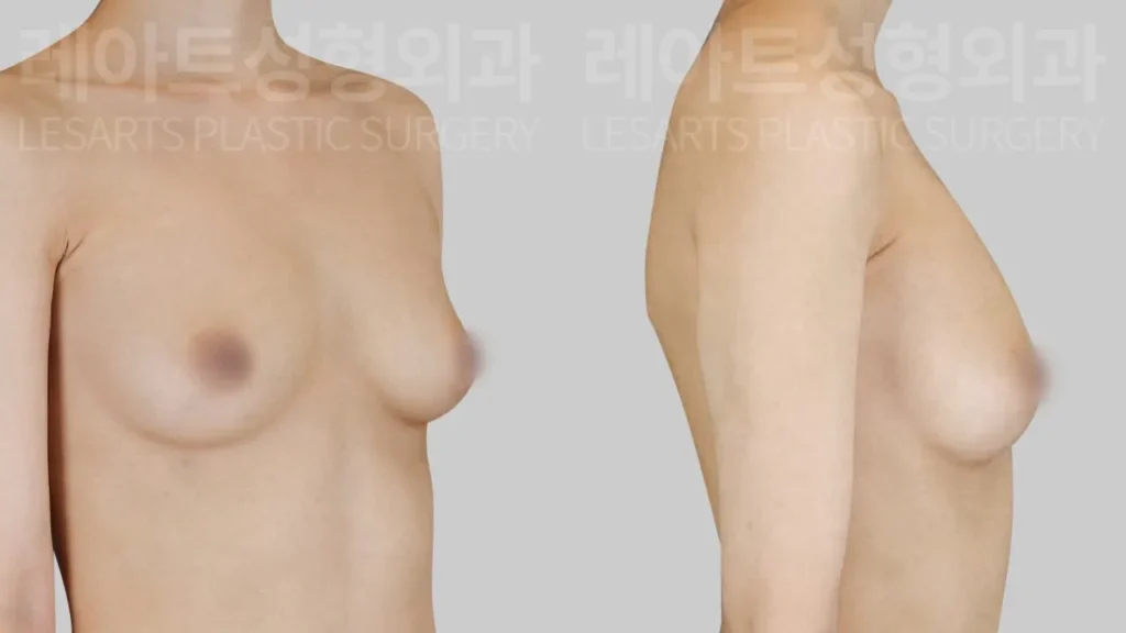 breast-fat-transfer-02-02-260818