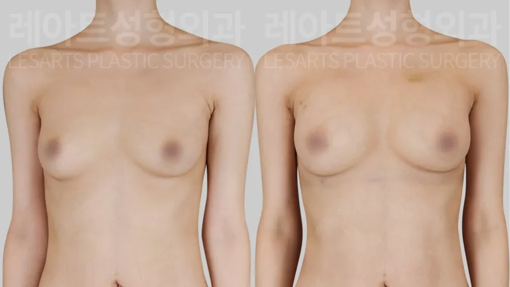 breast-fat-transfer-02-03-260818
