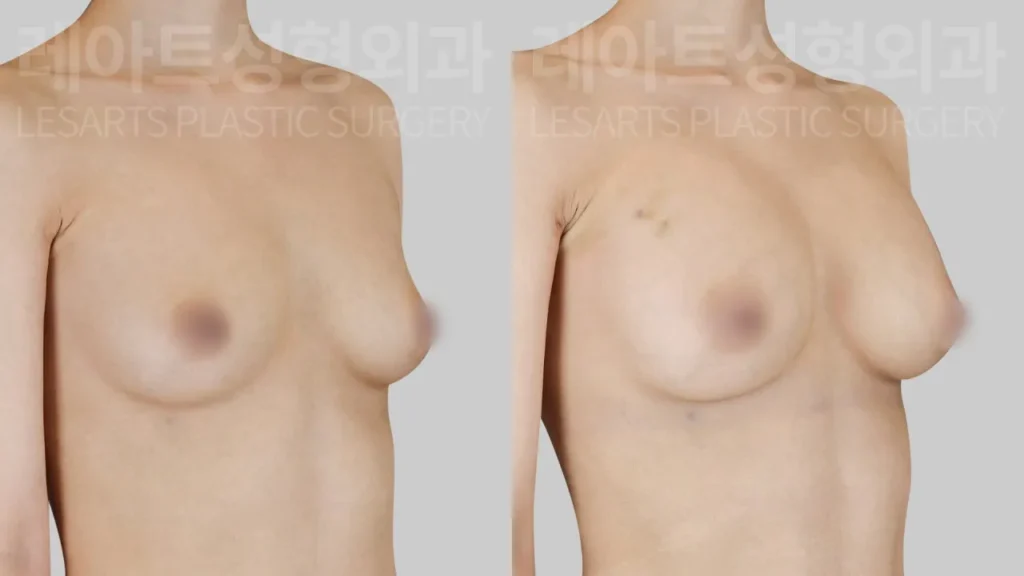 breast-fat-transfer-02-04-260818