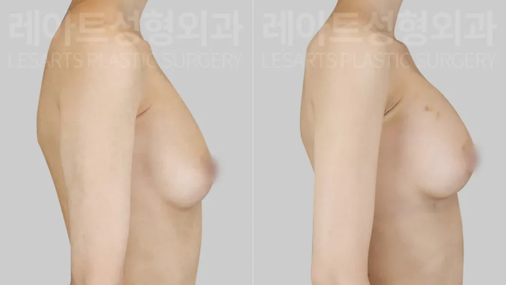 breast-fat-transfer-02-05-260818
