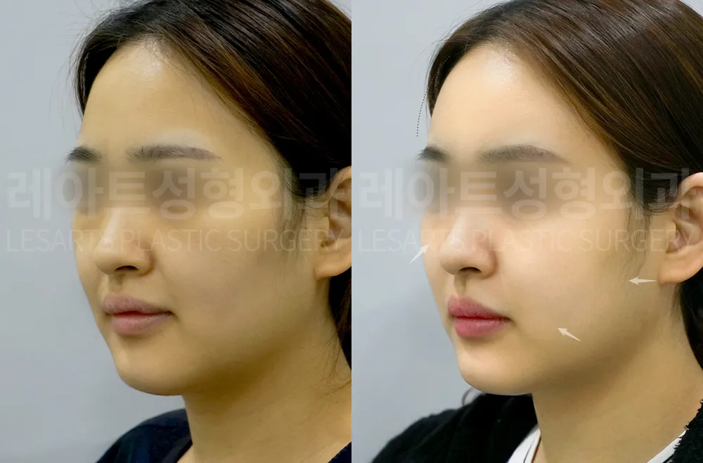 facial-fat-transfer-01-thumbnail-260813