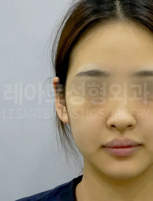 facial-fat-transfer-02-01-260813