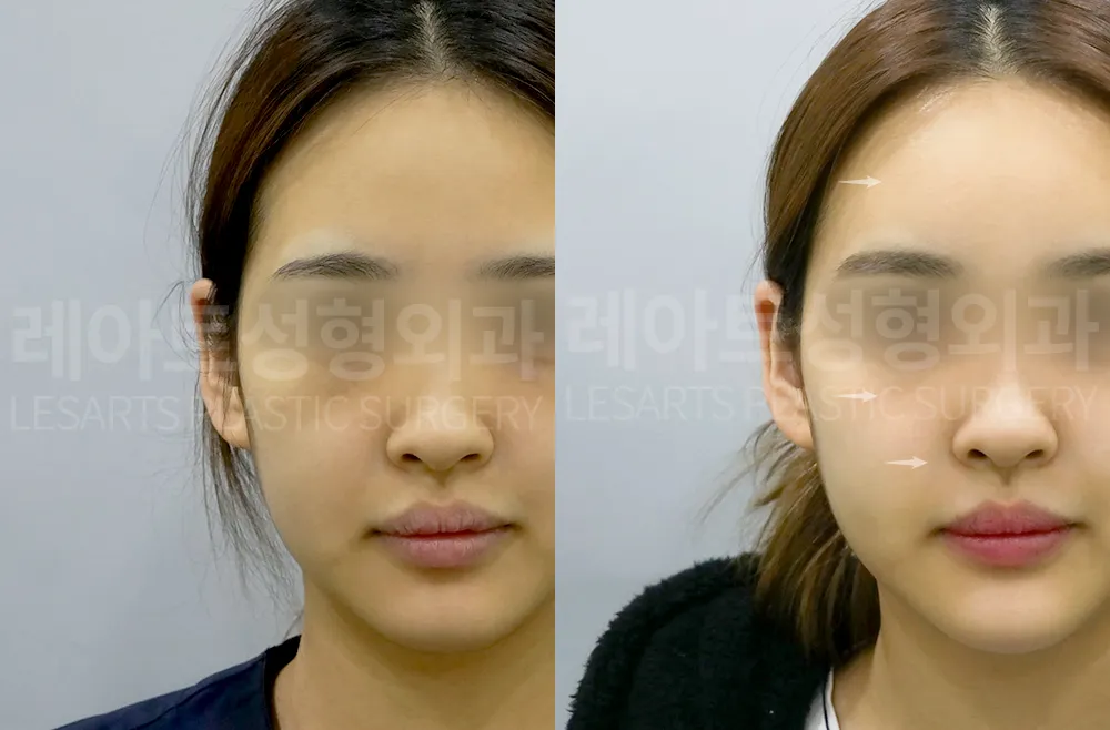 facial-fat-transfer-02-02-260813