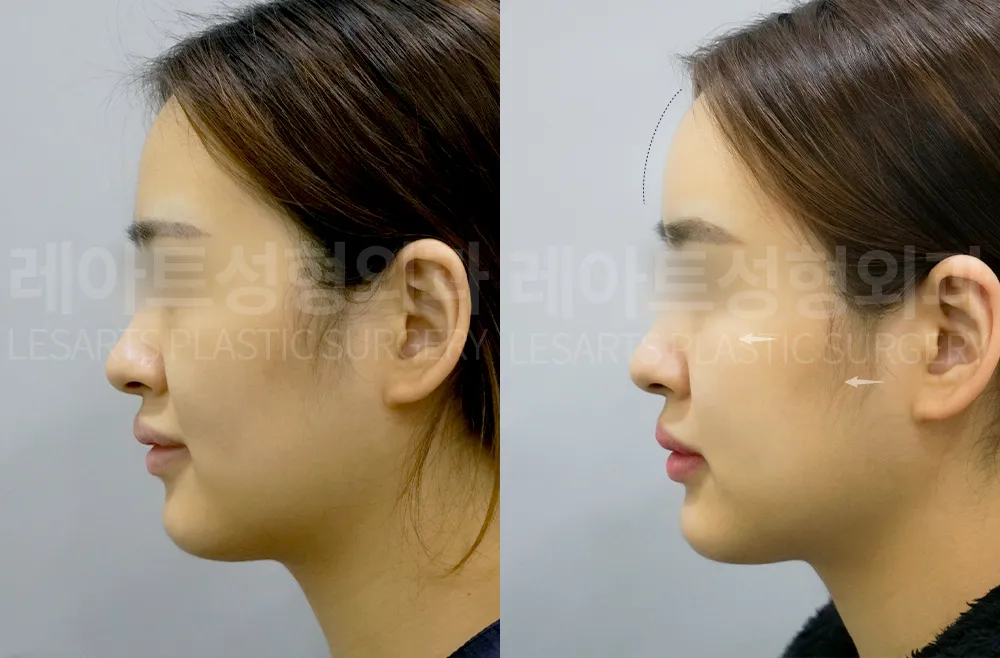 facial-fat-transfer-02-04-260813