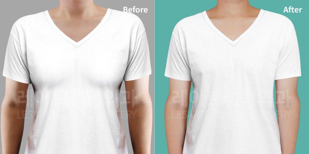 gynecomastia-02-01-260812