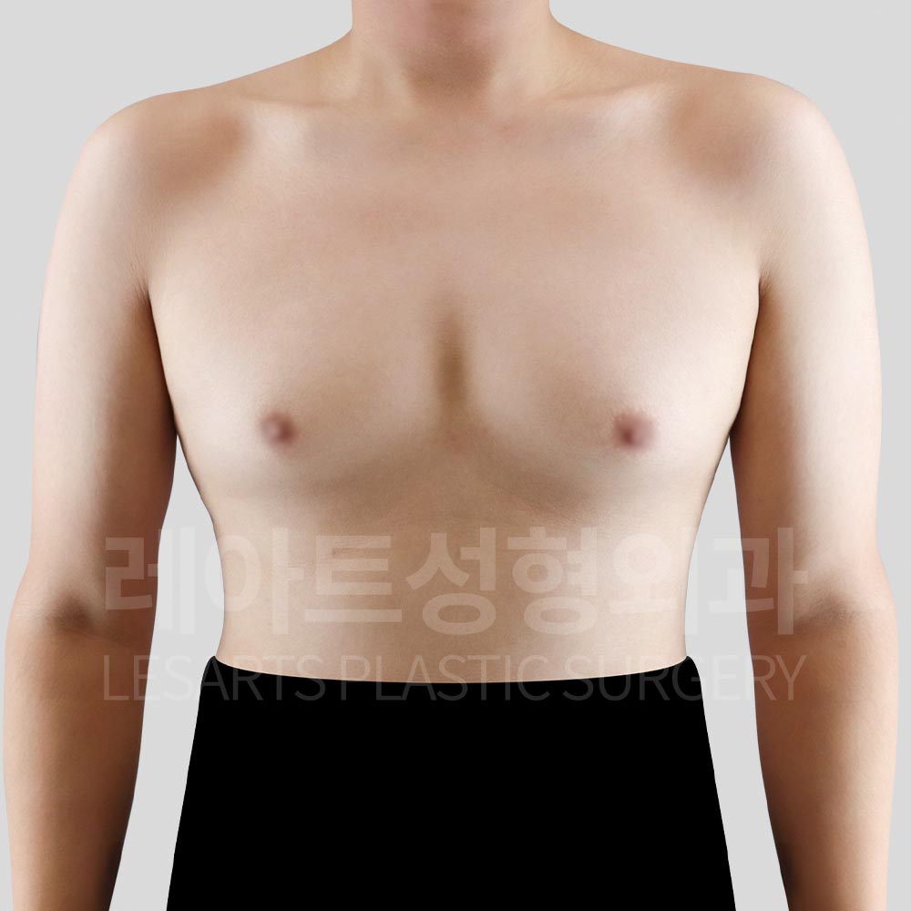 gynecomastia-02-02-260812