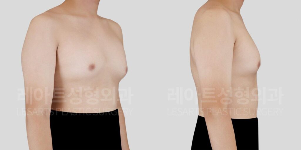 gynecomastia-02-03-260812