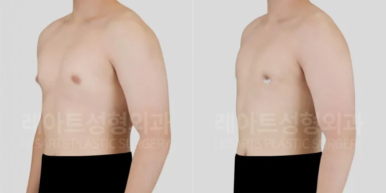 Gynecomastia surgery in Seoul: 2-week results for chest protrusion persisting since adolescence